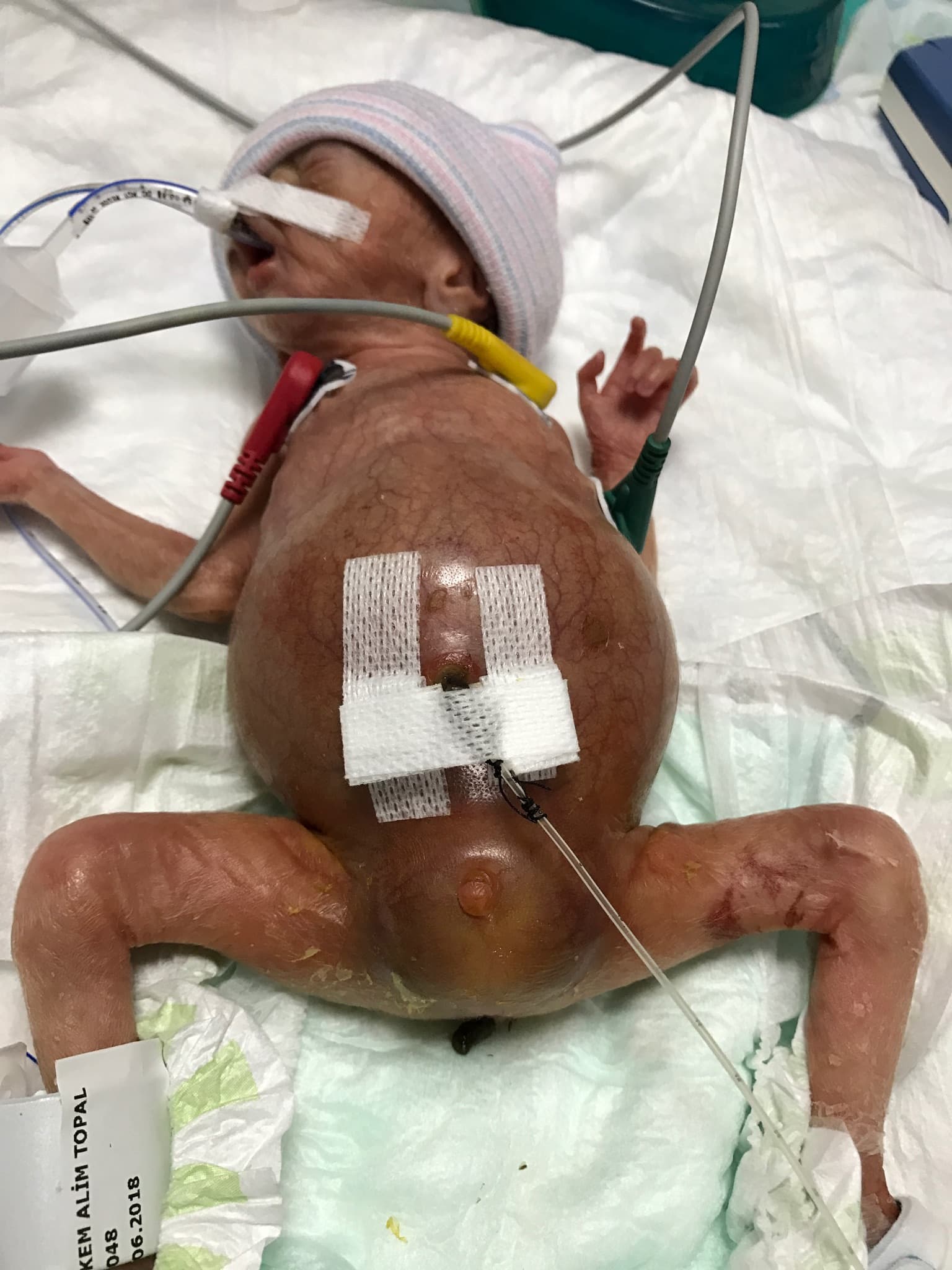 Prenatal Hidronefroz — bilgilendirme görseli